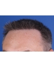 After Hair Transplant&nbsp;2 Sessions (Areas)